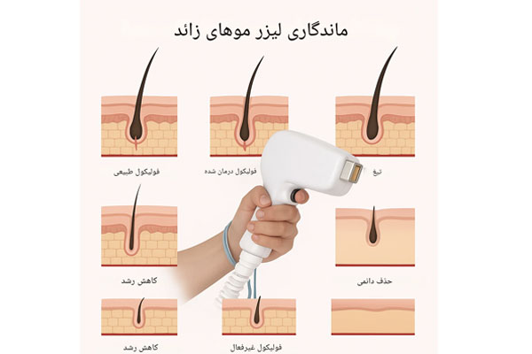 عمر لیزر موهای زائد