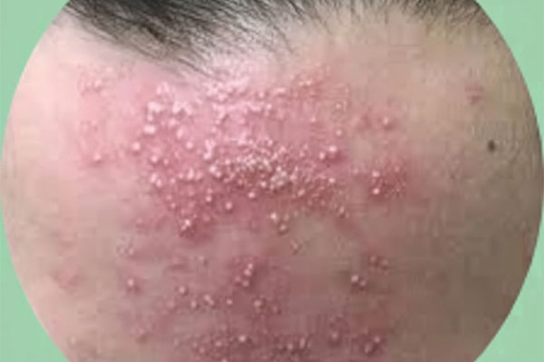 جوش بعد از لیزر موهای زائد جوش بعد از لیزر موهای زائد