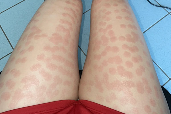 لک بعد از لیزر موهای زائد لک بعد از لیزر موهای زائد