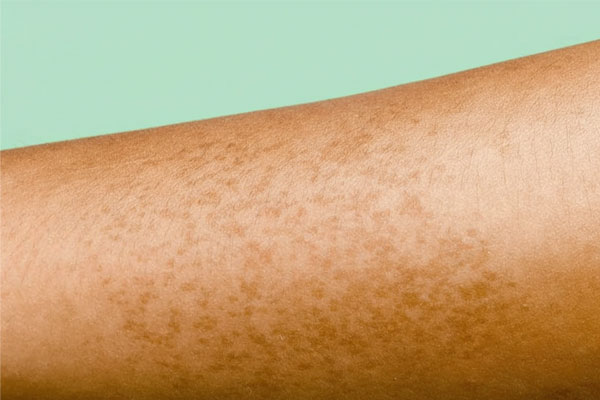 سوختگی بعد از لیزر سوختگی بعد از لیزر