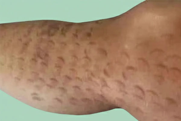 تفاوت عوارض در نواحی مختلف لک بعداز لیزر