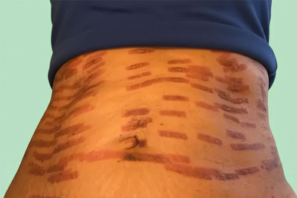 سوختگی با لیزر