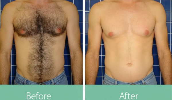 چند جلسه لیزر برای از بین بردن مو