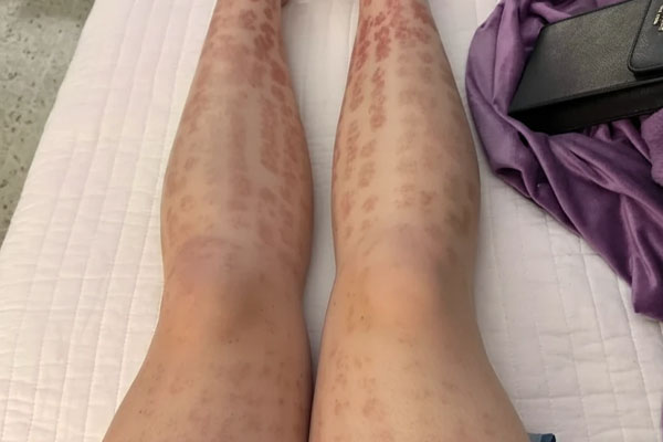 خطر های لیزر موهای زائد