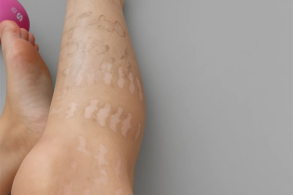 سوختگی پوستی لیزر