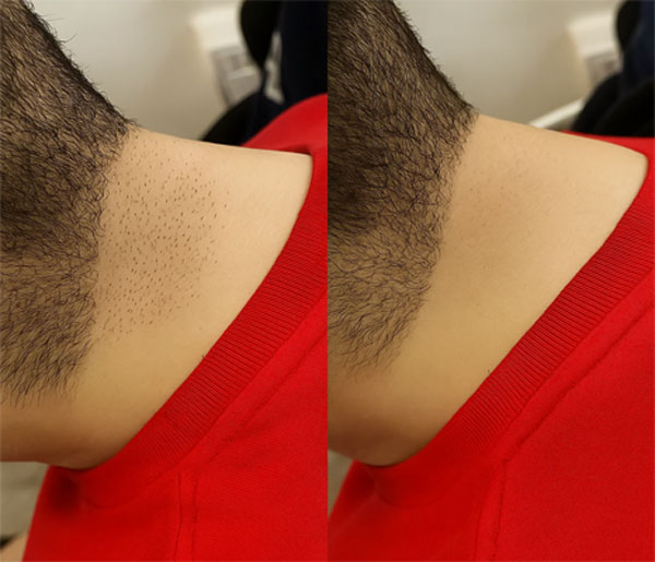 لیزر مخصوص آقایان